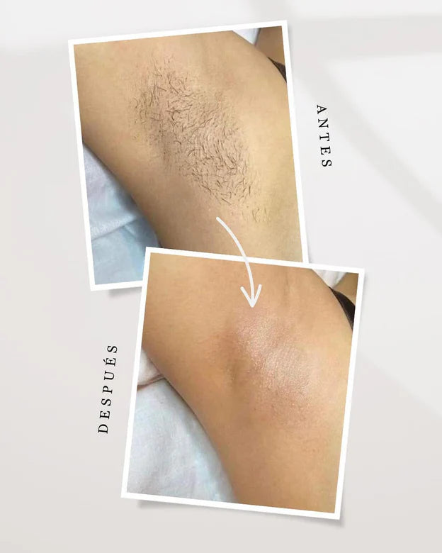 Depiladora Laser IPL